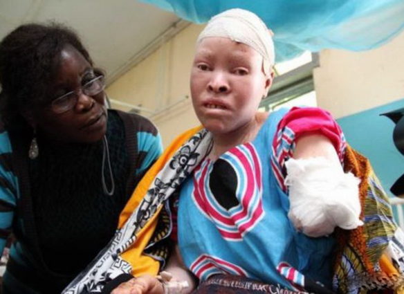 albinos